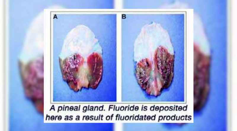5 Calcified Pineal Gland